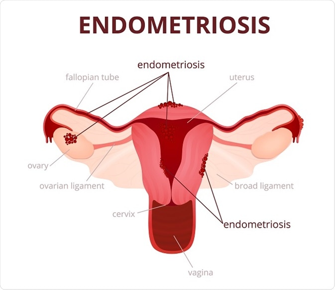 surrogacy-disqualifications-endometriosis